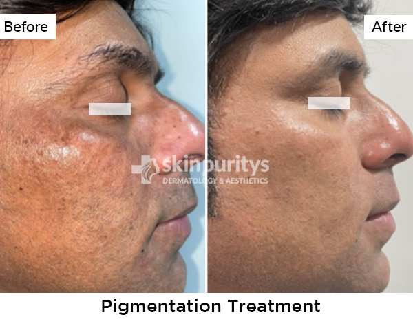 Pigmentation results